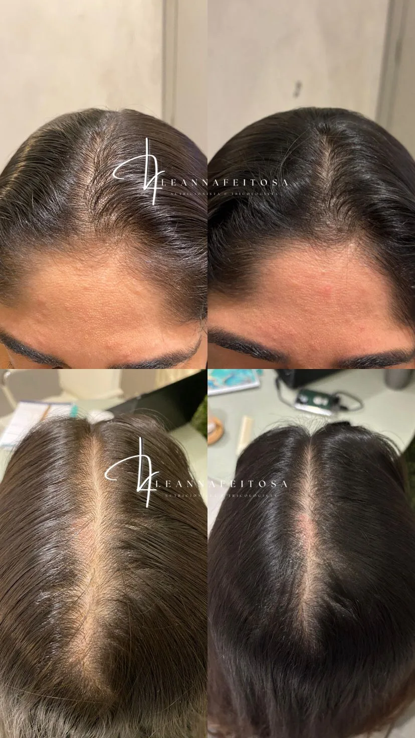 Tratamento para queda de cabelo – antes e depois