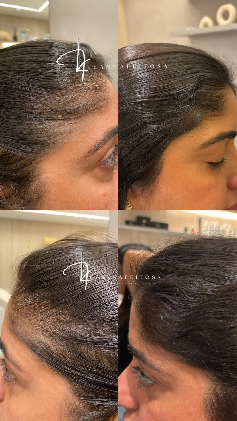 Tratamento para calvície – antes e depois