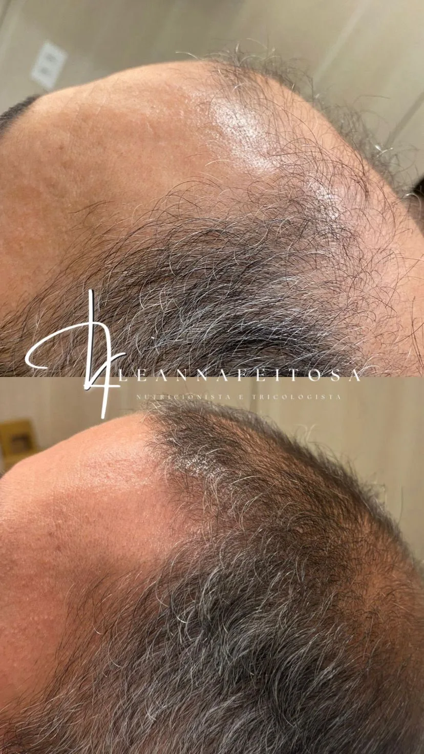 Tratamento para calvície – antes e depois
