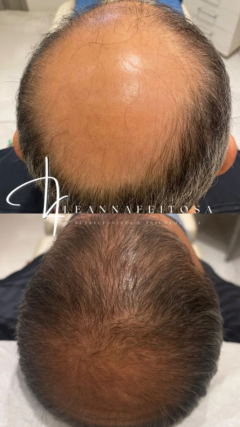 Tratamento para calvície – antes e depois