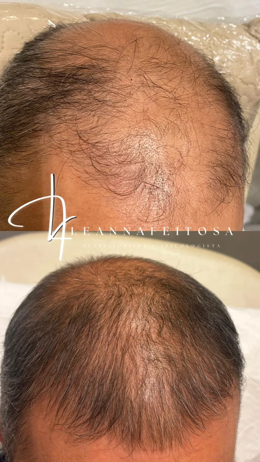 Tratamento para calvície – antes e depois