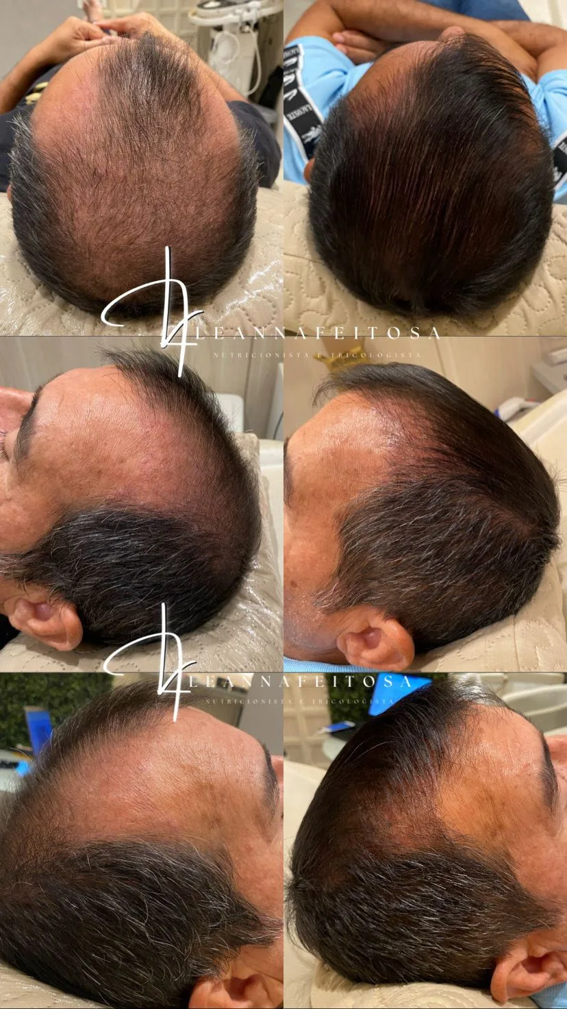 Tratamento para calvície – antes e depois