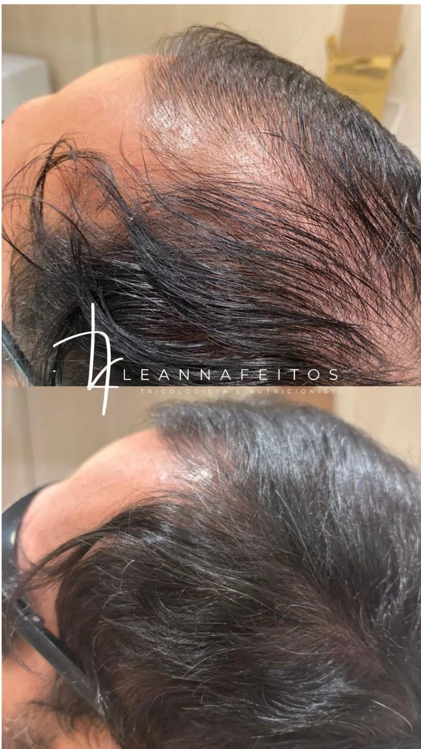 Tratamento para calvície – antes e depois