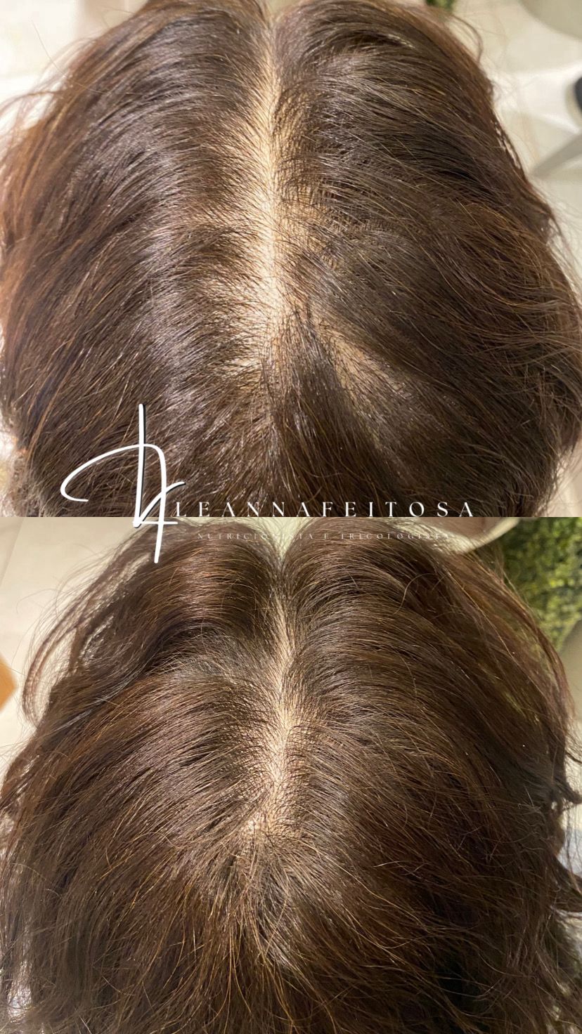 Tratamento para queda de cabelo – antes e depois